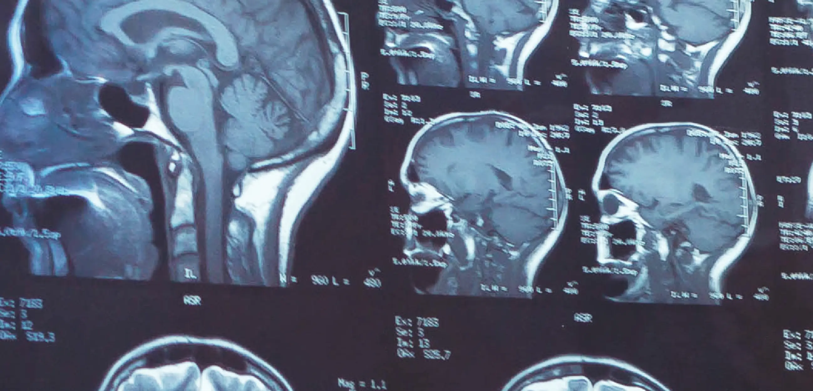 Inteligencia Artificial para el diagnóstico de patologías neurológicas por RMI