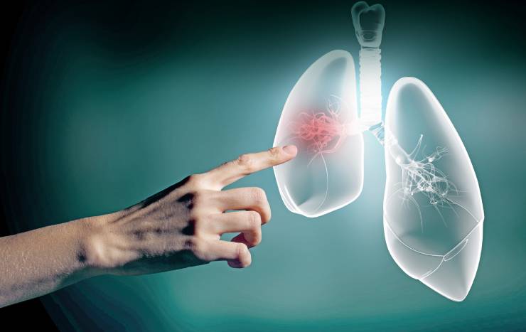 Cáncer de pulmón: llegar a tiempo salva vidas
